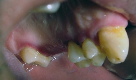Figure 1: Patient with linear gingival erythema (LGE)