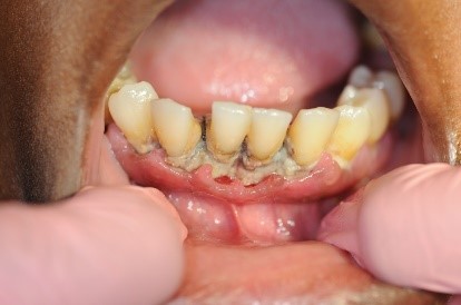 Figure 2: Patient with necrotizing ulcerative periodontitis (NUP)