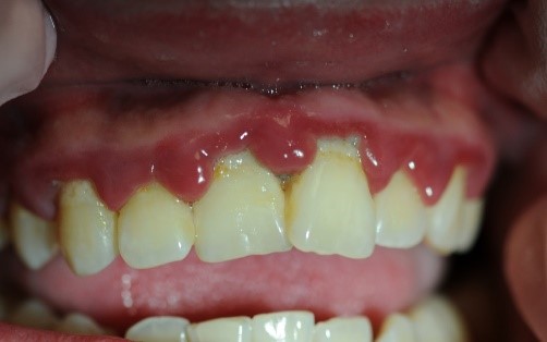Figure 3: Patient with linear gingival erythema (LGE) and necrotizing ulcerative periodontitis (NUP)