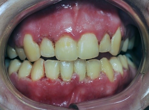 Figure 5: Patient with necrotizing ulcerative gingivitis (NUG)
