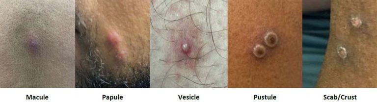 Figure 1: Stages of Mpox Lesions