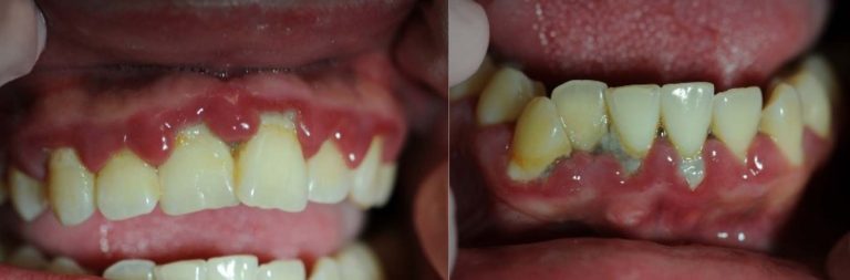 Two photographs showing teeth and gumline of patient with both linear gingival erythema and necrotizing ulcerative periodontitis.