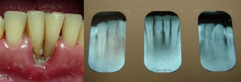 Photograph (left) and X-rays of 3 sections (right) of teeth and gumline of patient with localized bone loss.